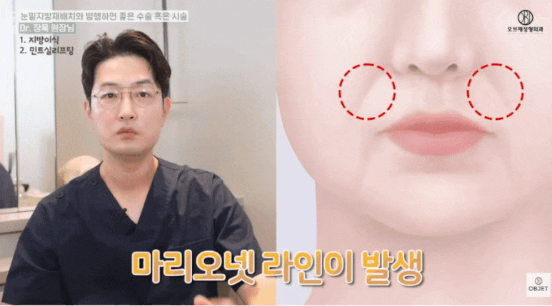 눈밑지방재배치수술후 시술? 장욱 원장님이 추천하는 <세 가지> 관련 이미지 5