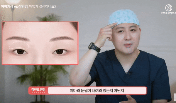 Can Forehead Lift Surgery Improve the Ability to Open Your Eyes Before and After? Dr. Hyun-jo Kim Explains! image 5