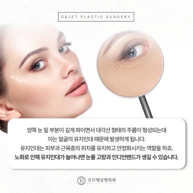 늘어지고 처지는 중년눈수술 관련 이미지 8