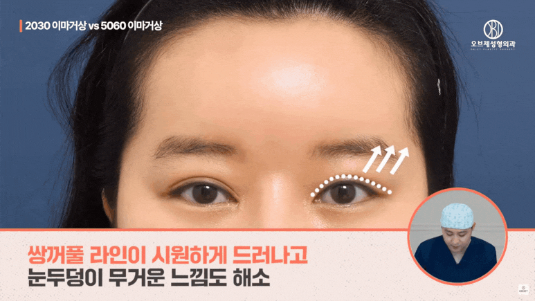 Forehead Lift in Your 20s: Why MZ Is Choosing It Instead of Double Eyelid Surgery image 9