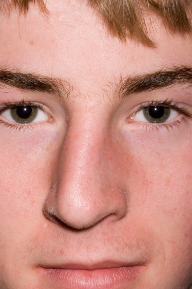 How to Resolve Nasal Congestion with Rhinoplasty, Obje Plastic Surgery image 2