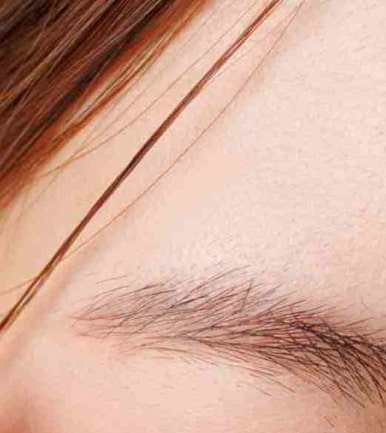 The Difference Between Upper Blepharoplasty and Incisional Double Eyelid Surgery #Director Kim Hyun-jo image 9