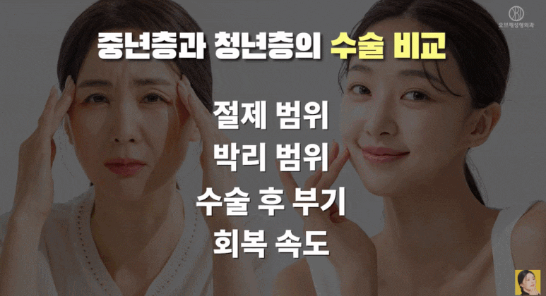 Worried About the Recovery Process After Upper Eyelid Surgery? Knowing ‘This’ Will Help You Recover Faster. (Recommended by a Board-Certified Plastic Surgeon) image 2