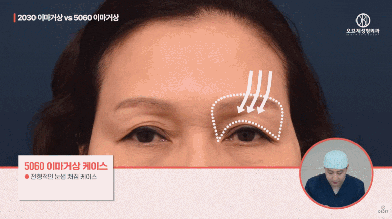 40대 이마거상과 20대 30대의 이마거상의 차이점 전격 비교! (성형외과 전문의 설명) 관련 이미지 11