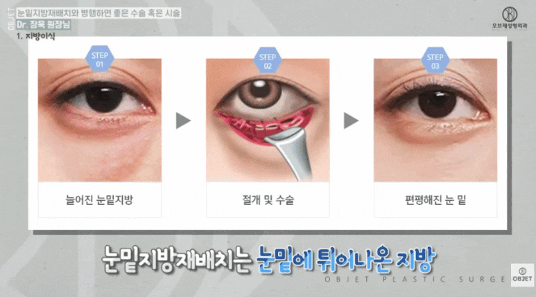 눈밑지방재배치수술후 시술? 장욱 원장님이 추천하는 <세 가지> 관련 이미지 2