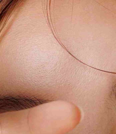 Questions About Double Eyelid Surgery in Gangnam image 9