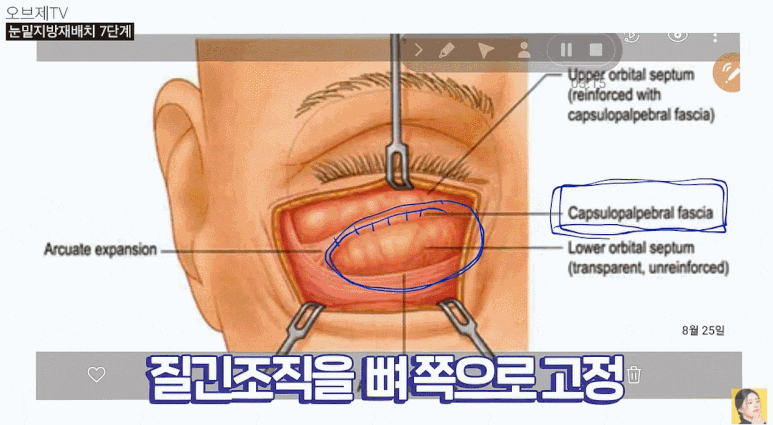 Under-Eye Fat Repositioning Surgery Method? Do It This Way and Worries About Recurrence Disappear. image 12