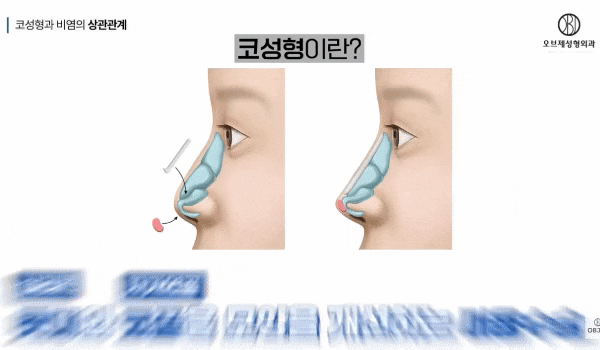 Recommended Clinic for Rhinitis Surgery: Can Functional Rhinoplasty Resolve Rhinitis? Revealing the Truth image 7