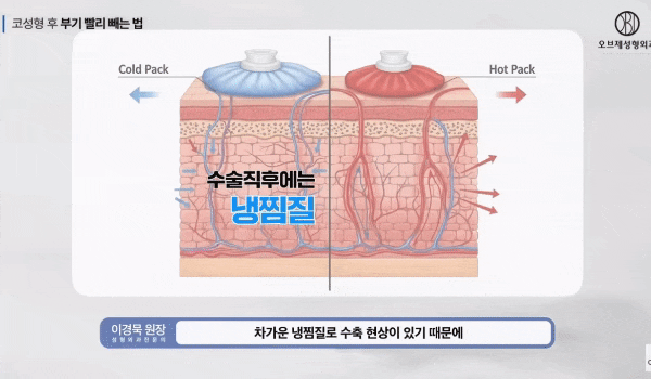 Tips from Director Lee Kyung-mook for Reducing Rhinoplasty Swelling and Shortening the Recovery Period! image 10
