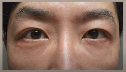 듀얼하안검 후기, 수술당일부터 69일까지 생생보고 #오브제성형외과 장욱원장님 관련 이미지 24