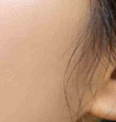 Brow Lift Procedure Method — Objet Plastic Surgery, Director Kim Hyun-jo image 18