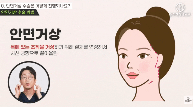 안면거상 전후, 자연스러움의 차이는 &lsquo;이것&rsquo;에서 결정됩니다 관련 이미지 4