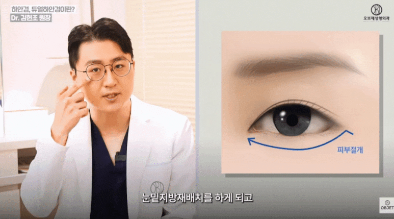 눈밑지 성형외과 유지 기간 평생 갈까? 김현조 원장님 정리 관련 이미지 11