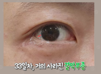 듀얼하안검 후기, 수술당일부터 69일까지 생생보고 #오브제성형외과 장욱원장님 관련 이미지 22