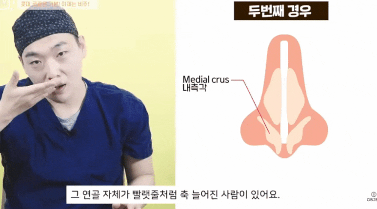 Tip Rhinoplasty: Don’t Overlook the Columella! A Summary by Dr. Lee Kyung-mook image 6