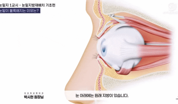 Can Lower Eyelid Hollowing Surgery Get Rid of Dark Circles? image 4