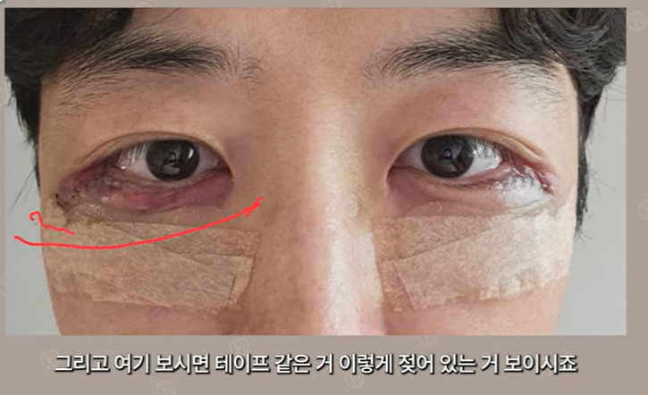 듀얼하안검 후기, 수술당일부터 69일까지 생생보고 #오브제성형외과 장욱원장님 관련 이미지 8