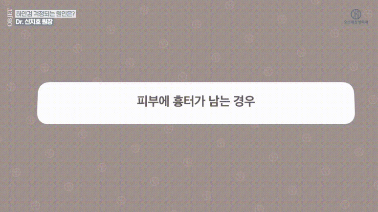 눈밑 뒤집힘, 애교살, 흉터 등 하안검수술 부작용 관련 이미지 6