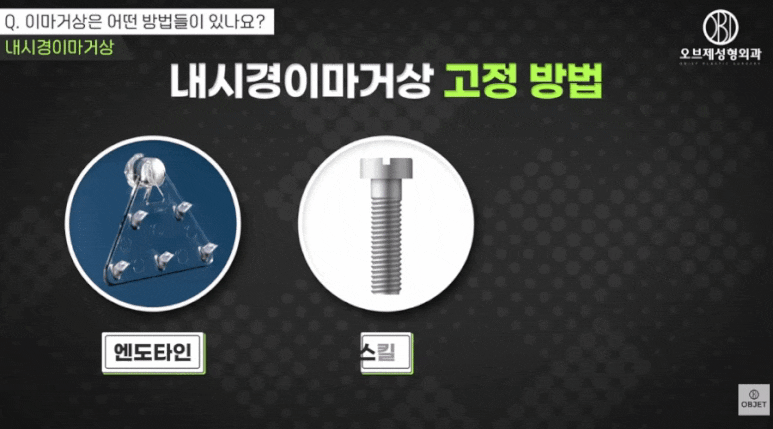 엔도타인이마거상? 신종인 원장님이 추천하는 <이유> 공개! 관련 이미지 4