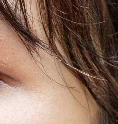 Brow Lift Procedure Method — Objet Plastic Surgery, Director Kim Hyun-jo image 15