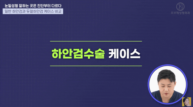 듀얼하안검, 눈밑지방재배치와 하안검을 동시에? 추천 대상과 회복 기간은? 관련 이미지 7