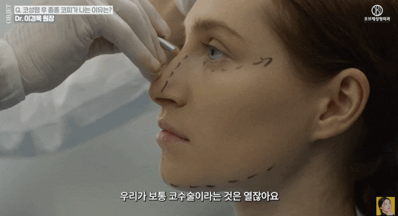 Everything You’ve Been Wondering About Rhinoplasty, Explained by a Rhinoplasty Clinic! (Answer from a Board-Certified Plastic Surgeon) image 6