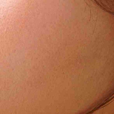 Various Types of Gangnam Thread Lifting image 10