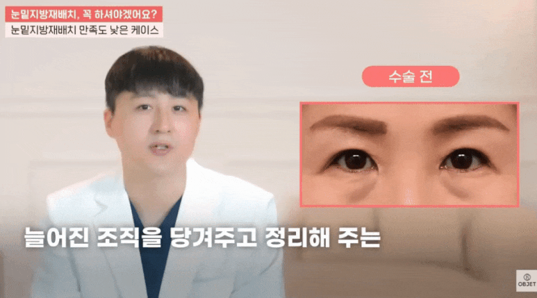 눈밑지방재배치 전후 흉터? 김현조 원장님의 <고민 타파> 관련 이미지 8