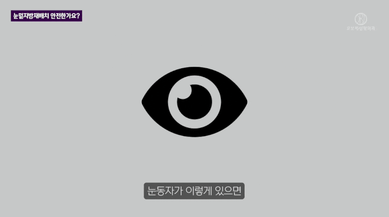 눈밑 지방재배치 수술, 가장 많이 들은 질문 TOP2는? 관련 이미지 10
