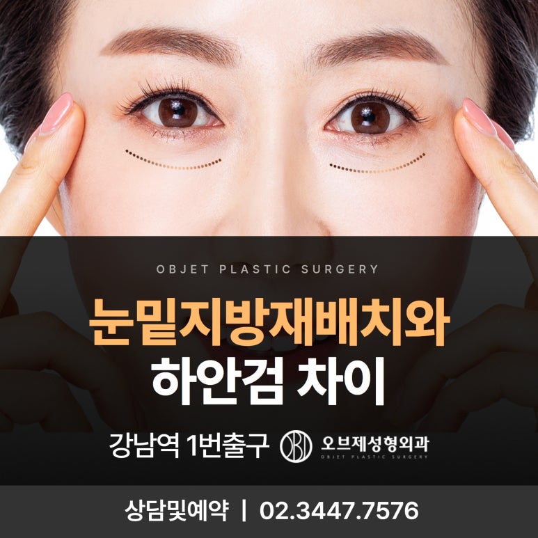 The Difference Between Lower Eye Fat Repositioning and Lower Blepharoplasty, the Snapback Test, and the Distraction Test #Gangnam Plastic Surgery Objet image 1