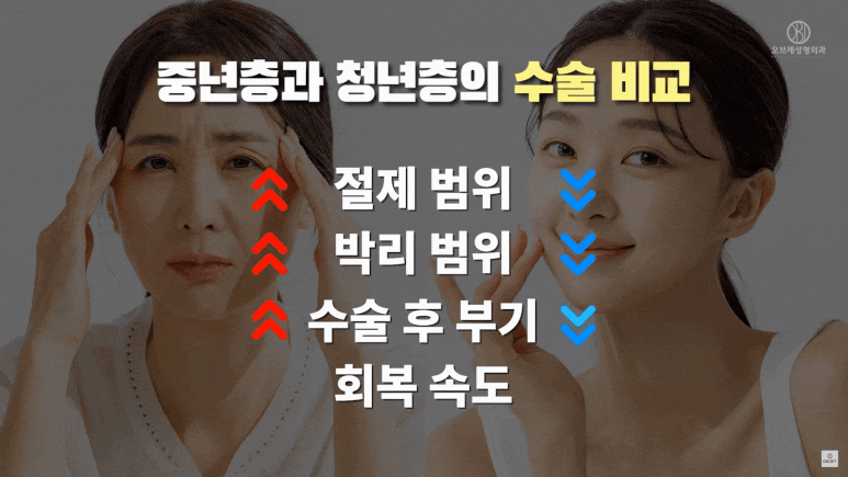 Upper Blepharoplasty Review: Worried You Won’t Be Able to Go to Work Because of Swelling? image 2