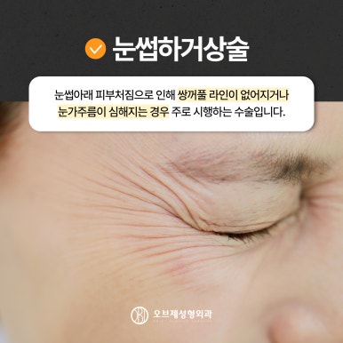 Fine Wrinkles Beside the Eyes, Brow Lift image 5