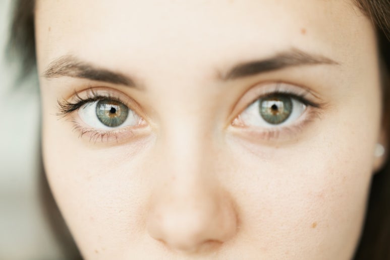 Dark Circle Causes: Are They Really This Diverse? image 3