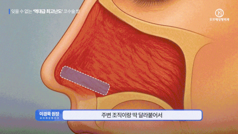 3번 재수술한 사람도 찾는 구축코수술잘하는곳, 뭐가 다를까요? 관련 이미지 4