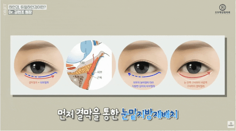 눈밑지 회복기간 휴가 써야겠죠? 김현조 원장님 답변! 관련 이미지 9