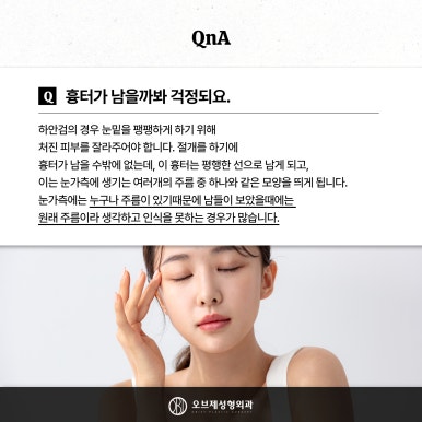 눈밑 뒤집힘, 애교살, 흉터 등 하안검수술 부작용 관련 이미지 7