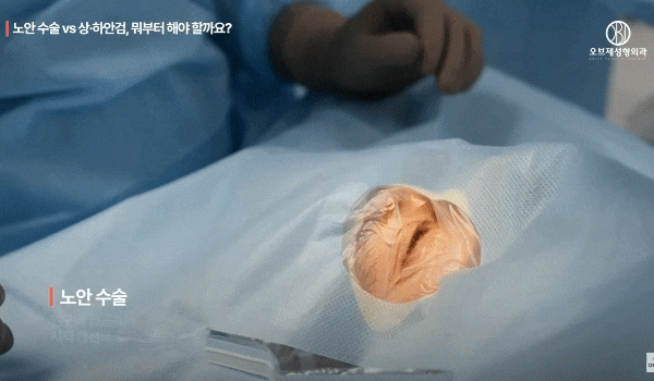 Upper and Lower Eyelid Surgery vs. Presbyopia Surgery: Which Should You Have First? image 4