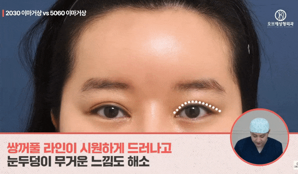 The Effects of a Forehead Lift in Your 20s? A Comprehensive Summary by Director Kim Hyun-jo image 3