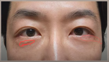 듀얼하안검 후기, 수술당일부터 69일까지 생생보고 #오브제성형외과 장욱원장님 관련 이미지 20