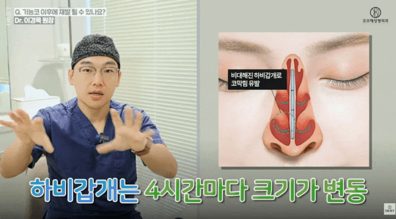 기능코성형 후 재발할 수 있다? 이경묵 원장님의 <Q&A> 관련 이미지 7