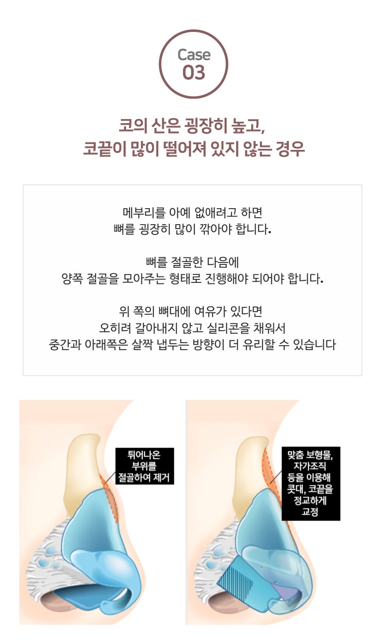 Causes of Hump Nose Rhinoplasty image 6