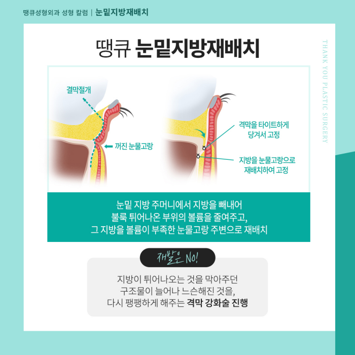 눈밑지 수술 후 얼굴처짐 생길까요? 관련 이미지 3