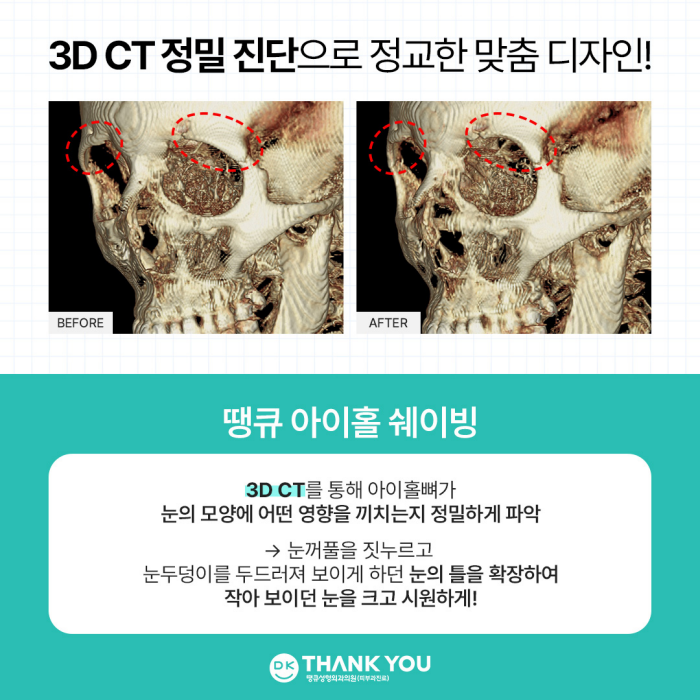 눈매개선, 눈성형으로 해결되지 않는다면?! 눈의 틀을 개선하는 아이홀쉐이빙 관련 이미지 4