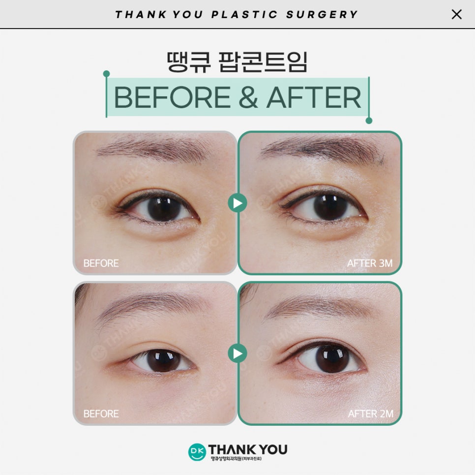 듀얼트임효과로 답답한 꼬막눈을 시원하게! 관련 이미지 9