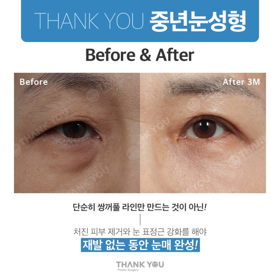 중년눈수술, 50대 60대 눈처짐과 눈꺼풀짓무름 해결법 관련 이미지 7