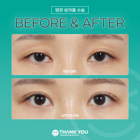 Double-Eyelid Surgery Line: Which One Suits Me Best? image 10