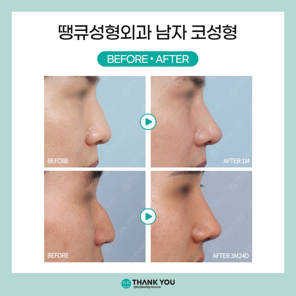 [남자코수술 전후] 코성형외과는 왜 땡큐일까?! 관련 이미지 5