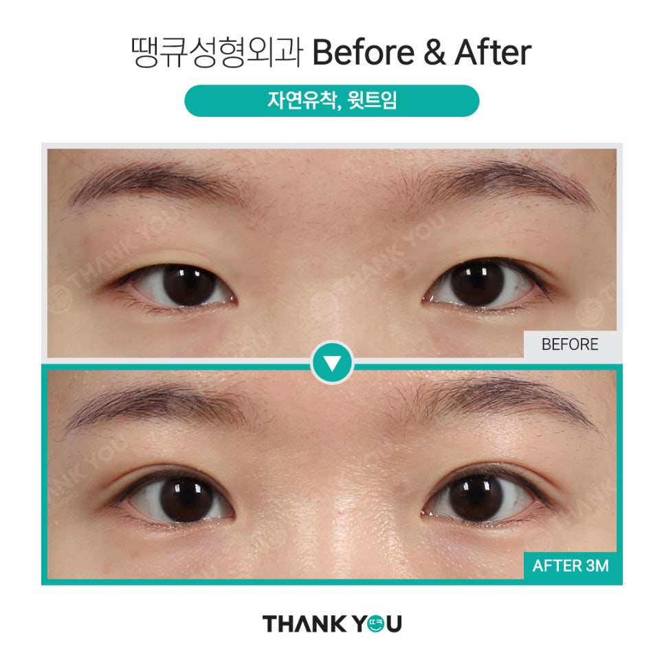 쌍수 윗트임 전후, 내게 맞춘 쌍트 수술로 화려하게 관련 이미지 6