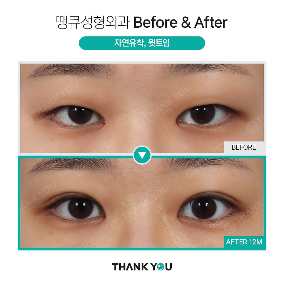 쌍수 뒷트임 (앞트임,밑트임, 듀얼트임 종류) 전후사진 관련 이미지 11
