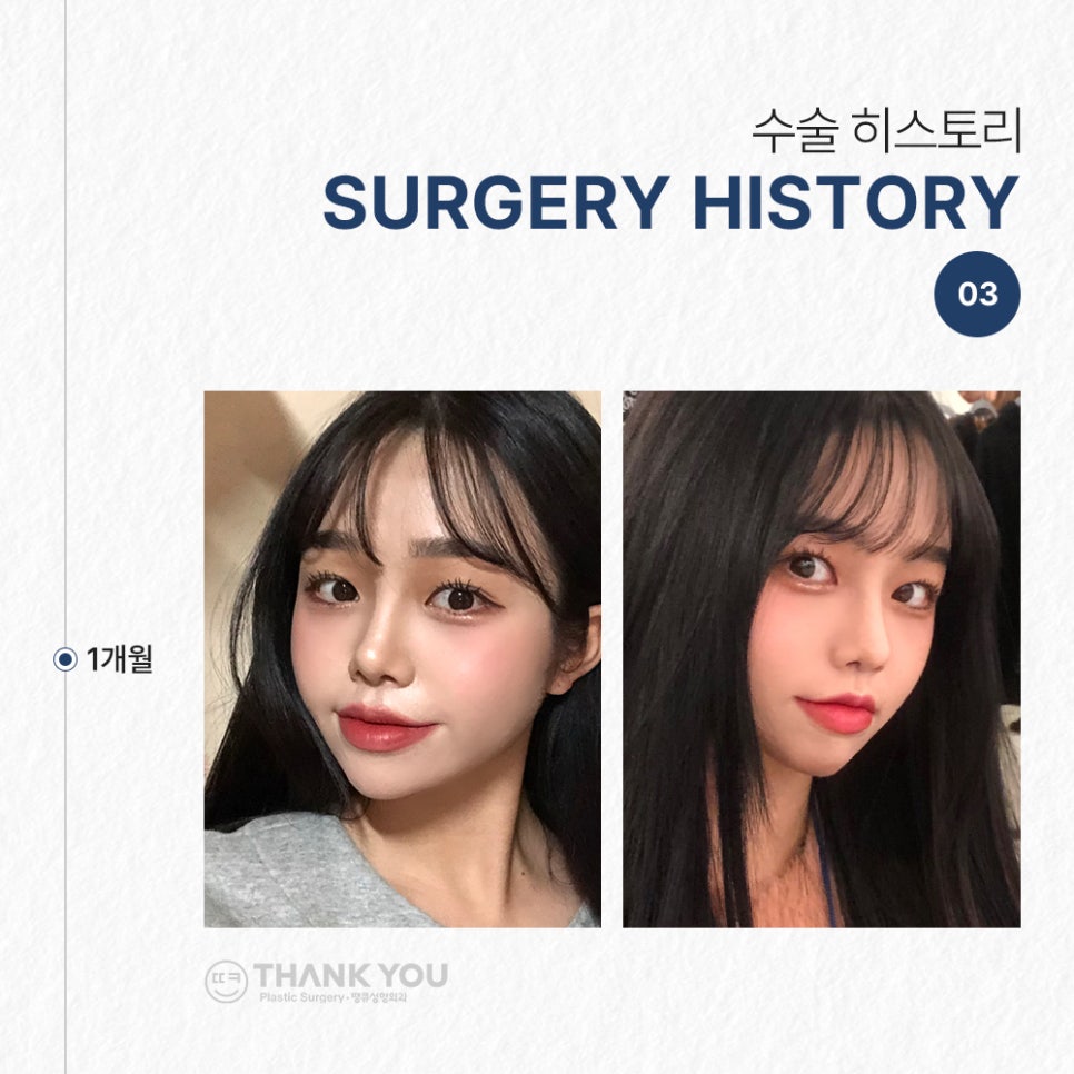 낮은코성형&얼굴지방흡입 후기 (땡큐성형외과 Real Story) 관련 이미지 6